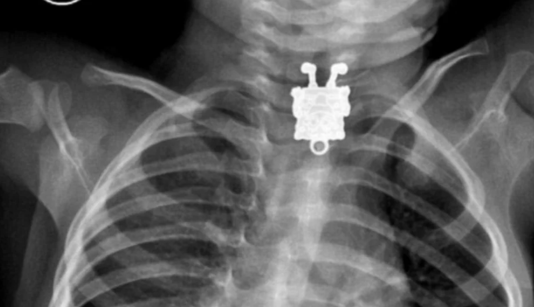 X-ray image showing a small toy lodged in a child&#x27;s throat