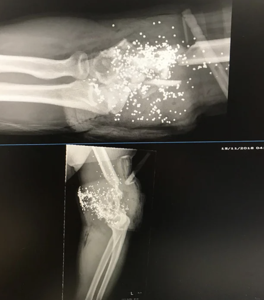 X-ray of a shattered elbow
