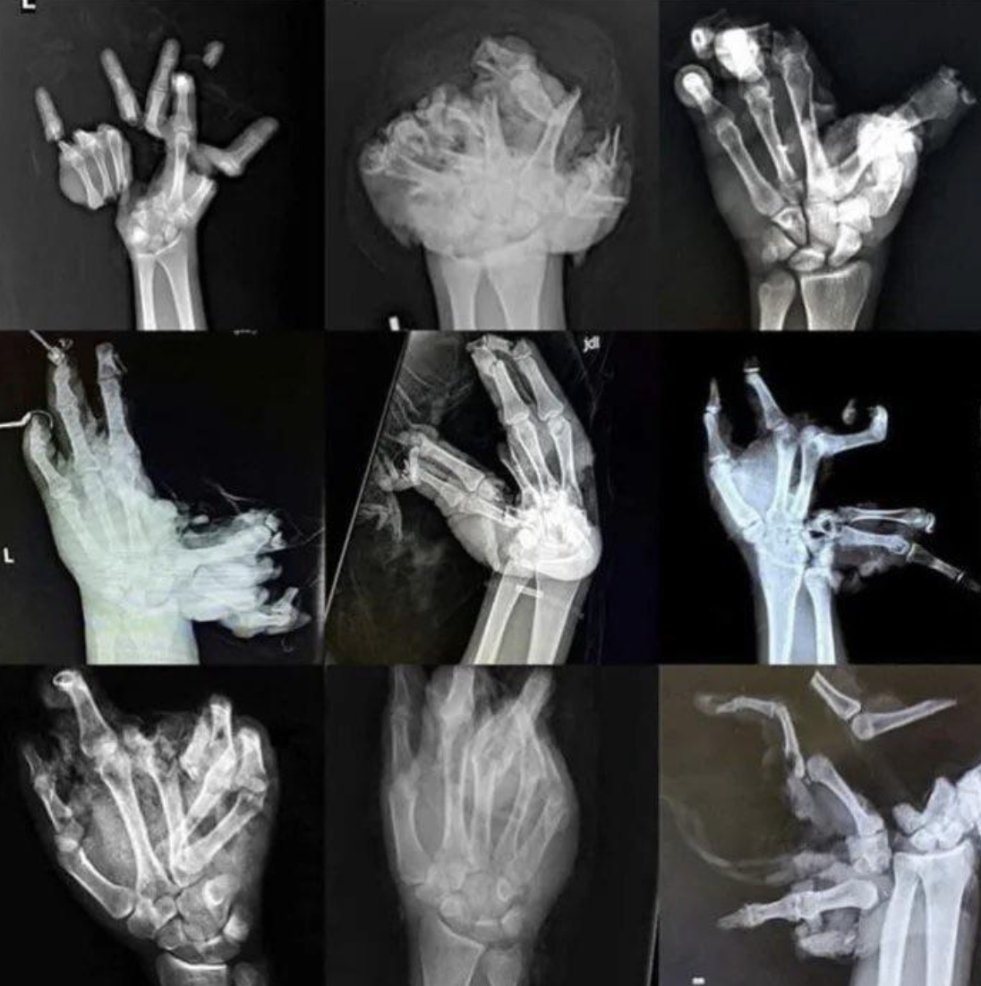 Multiple x-rays of hands