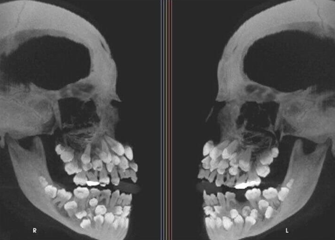 X-ray of a skull with unusually numerous teeth, an Internet Find highlighting dental abnormality