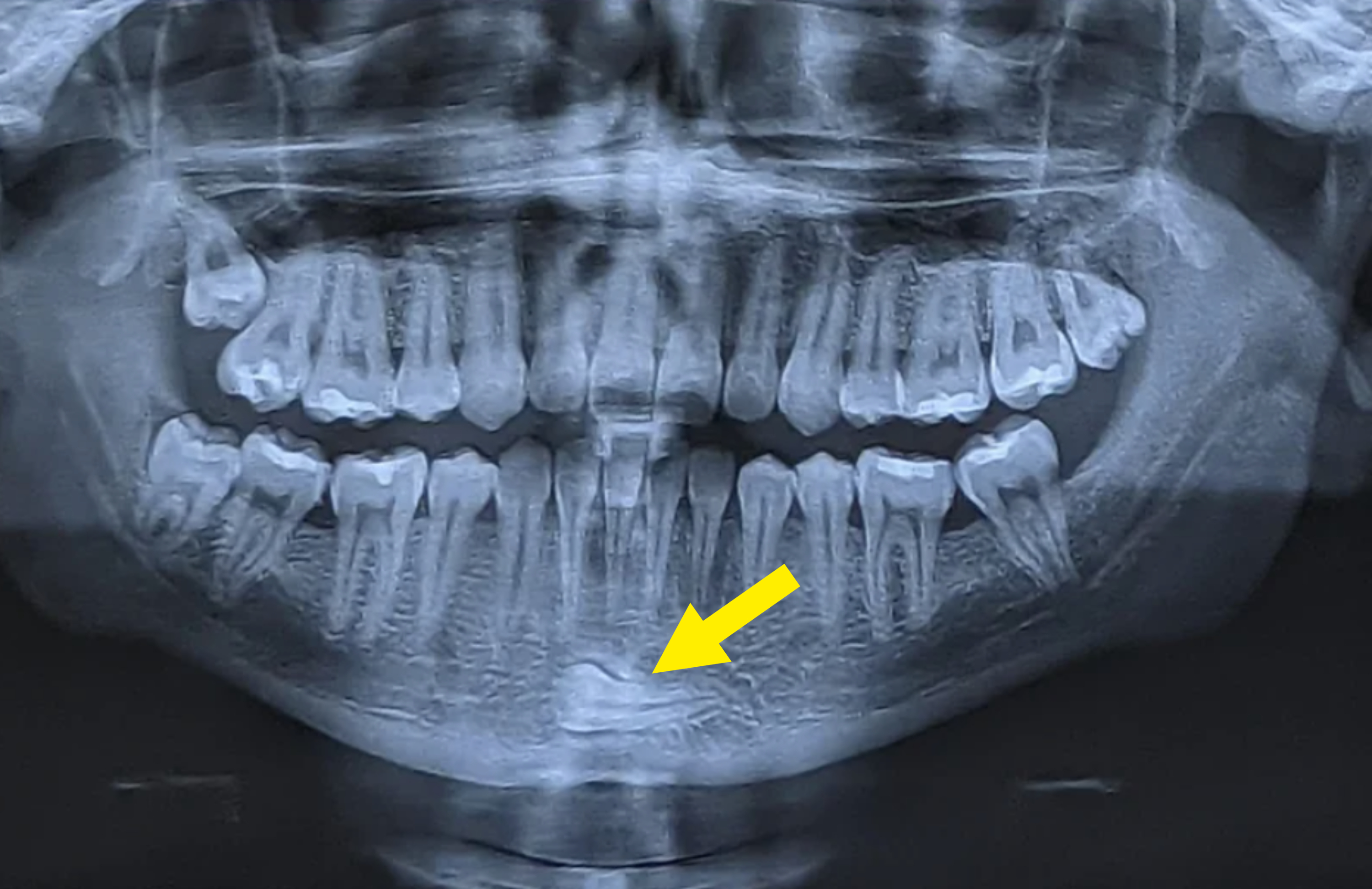 X-ray with an arrow pointing to a tooth in someone&#x27;s chin