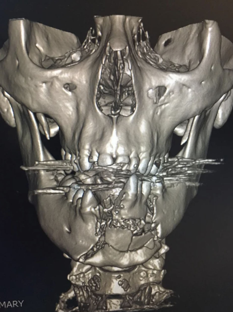 X-ray of a broken jaw