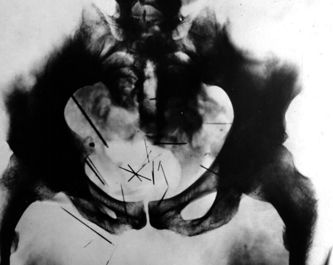 X-ray of Albert Fish&#x27;s pelvis