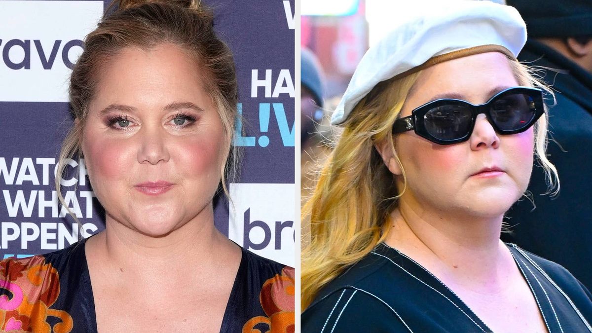 Amy Schumer slams critics of her 'puffier than normal' face