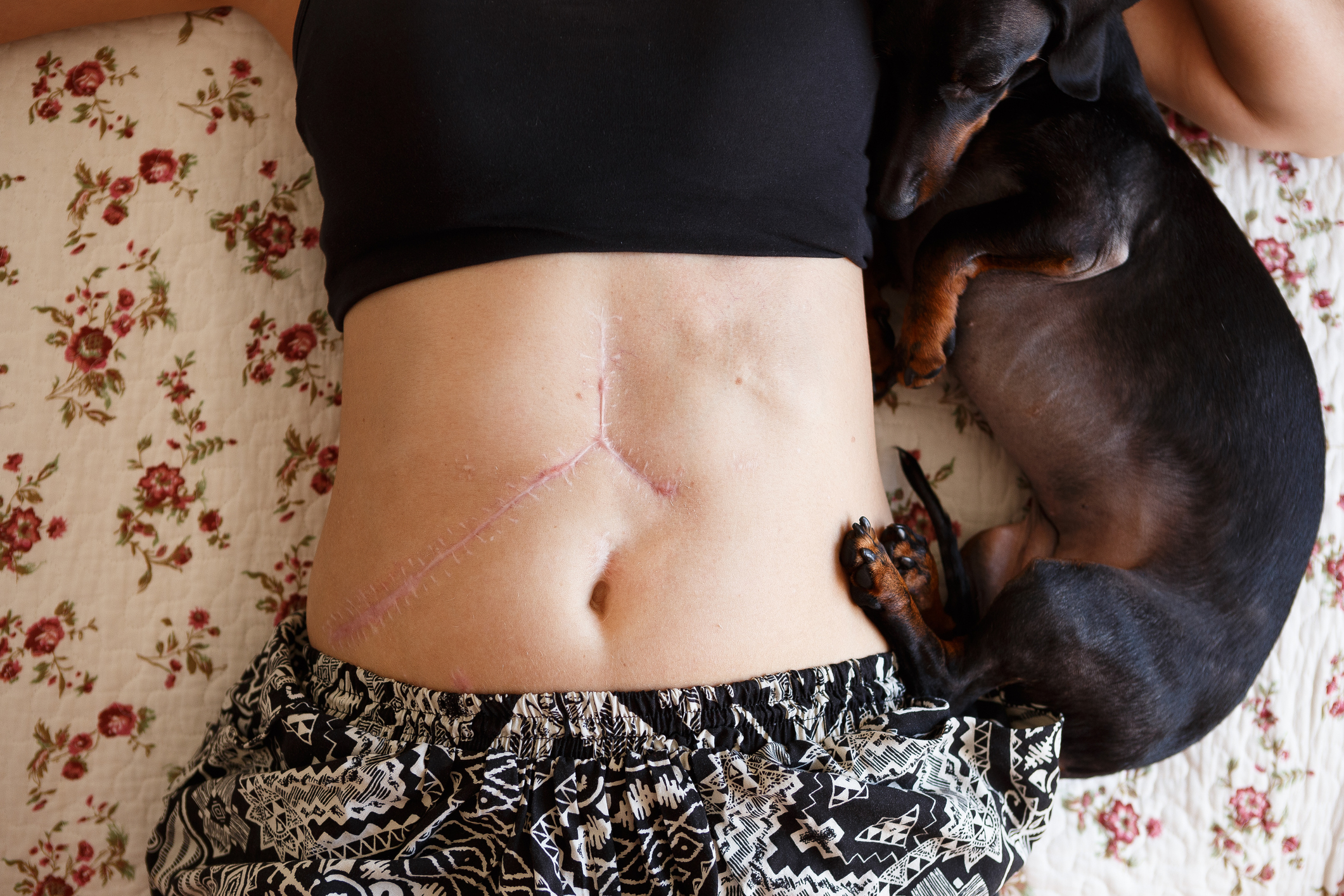 Person lying down with a scar on abdomen and a dachshund resting beside them