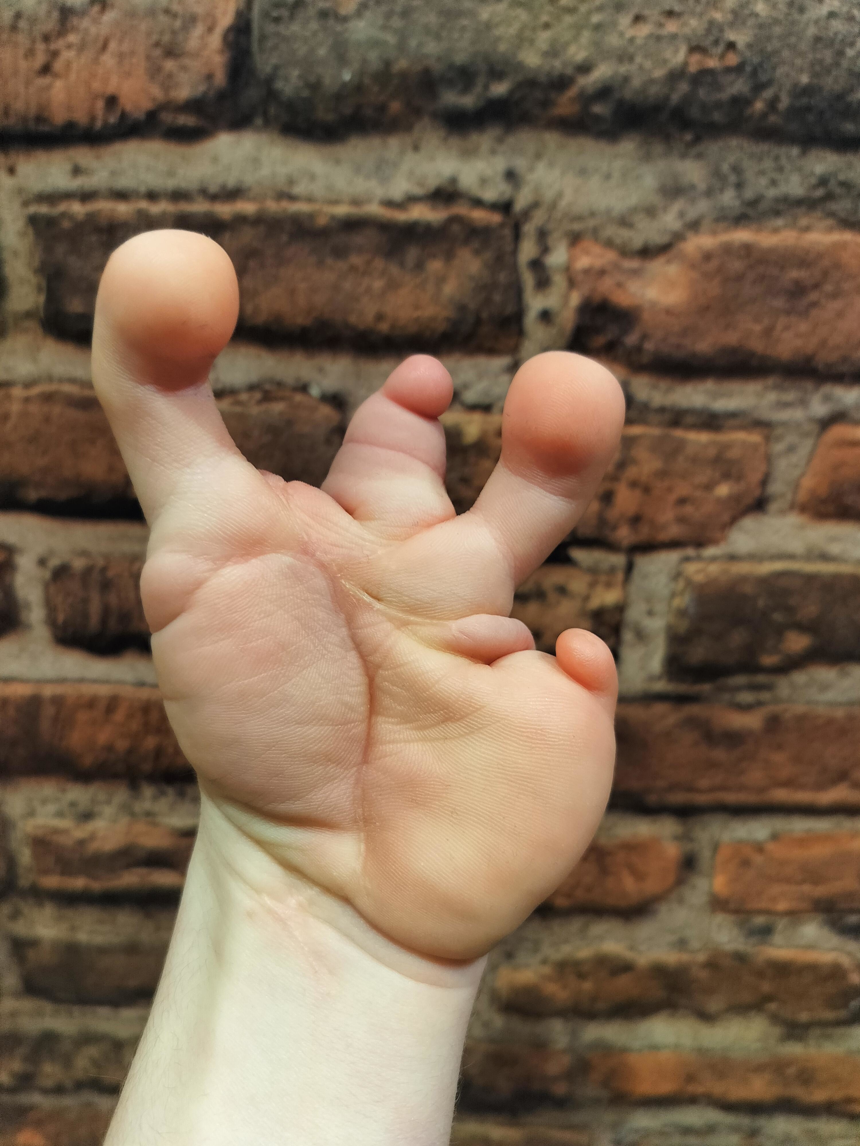 A person&#x27;s hand with double thumb mutation