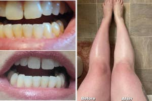 person with yellow teeth then same person with white teeth, review with one leg dry adn the other exfoliated