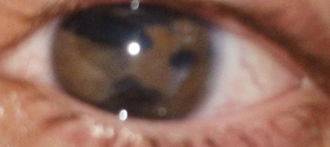 Close-up of a human eye with three pupils