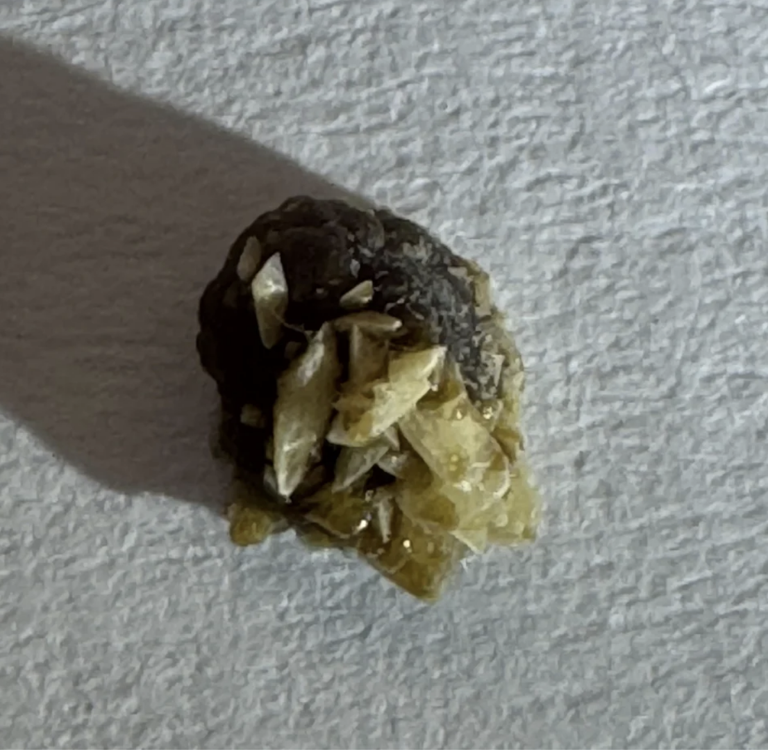 closeup of a kidney stone