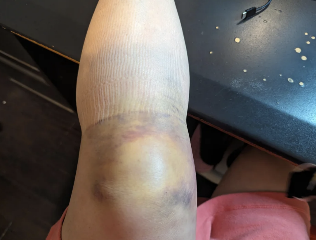 Person showing bruised knee close-up, with slight swelling visible, but not under the knee