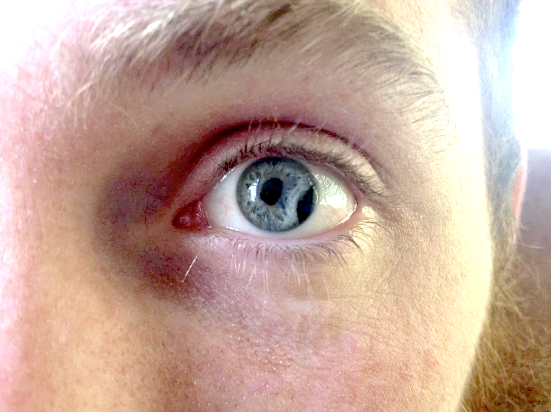 eye with detached pupil at edge of eye along with normal pupil