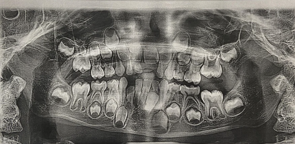 dental x-ray with baby teeth