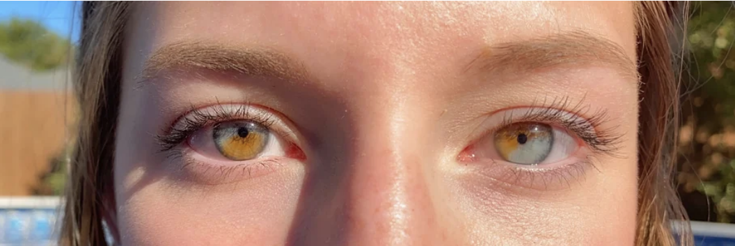 person with multiple colors in each eye