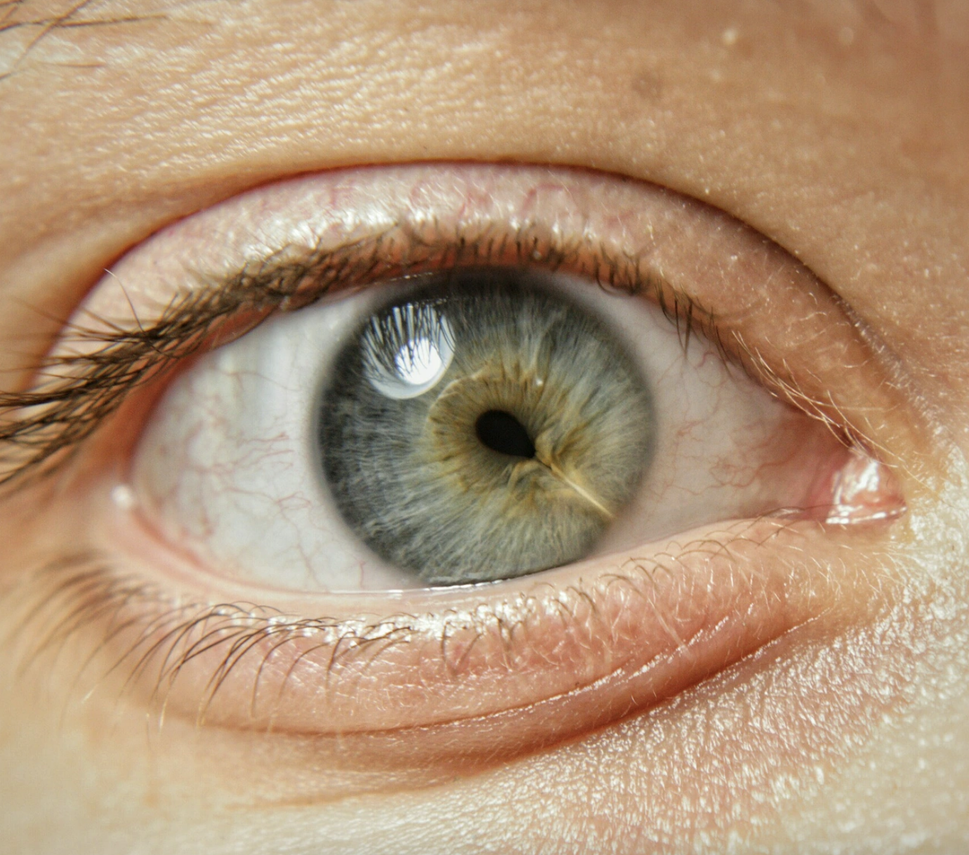Close-up of a human eye, with a scar on the iris