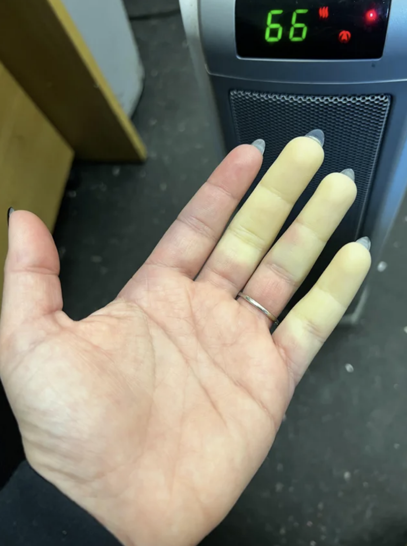 fingers turning yellow