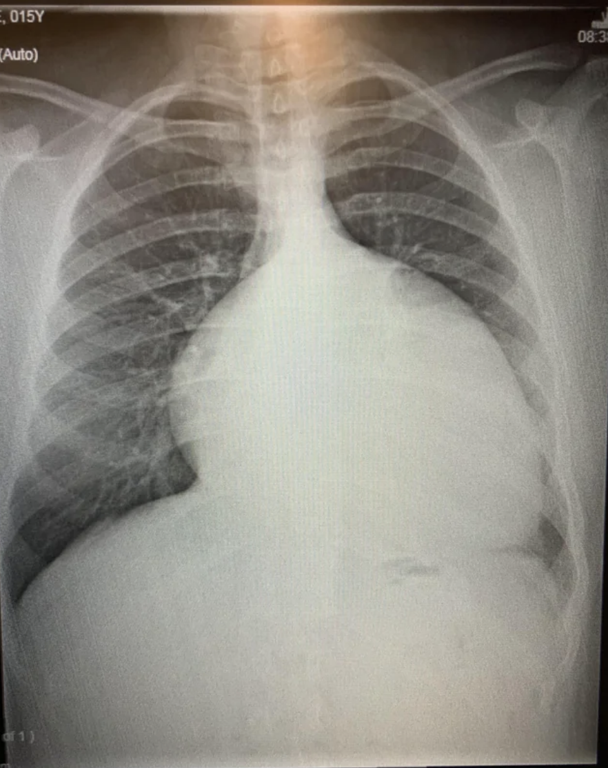 Chest X-ray showing lungs and large heart silhouette