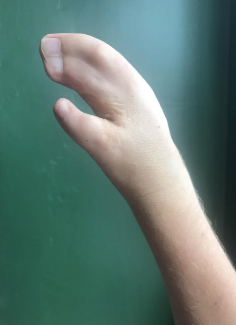 A human hand in a curved position with a thumb and two fingers fused together