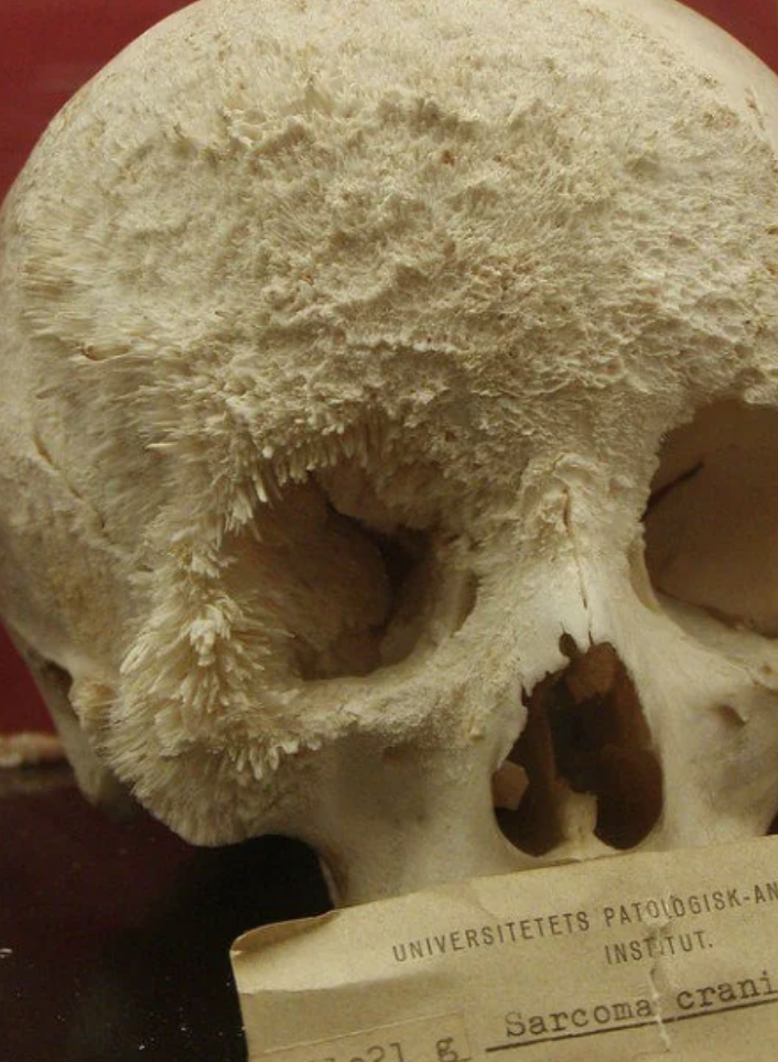 Human skull with pathological growths on display at an institute