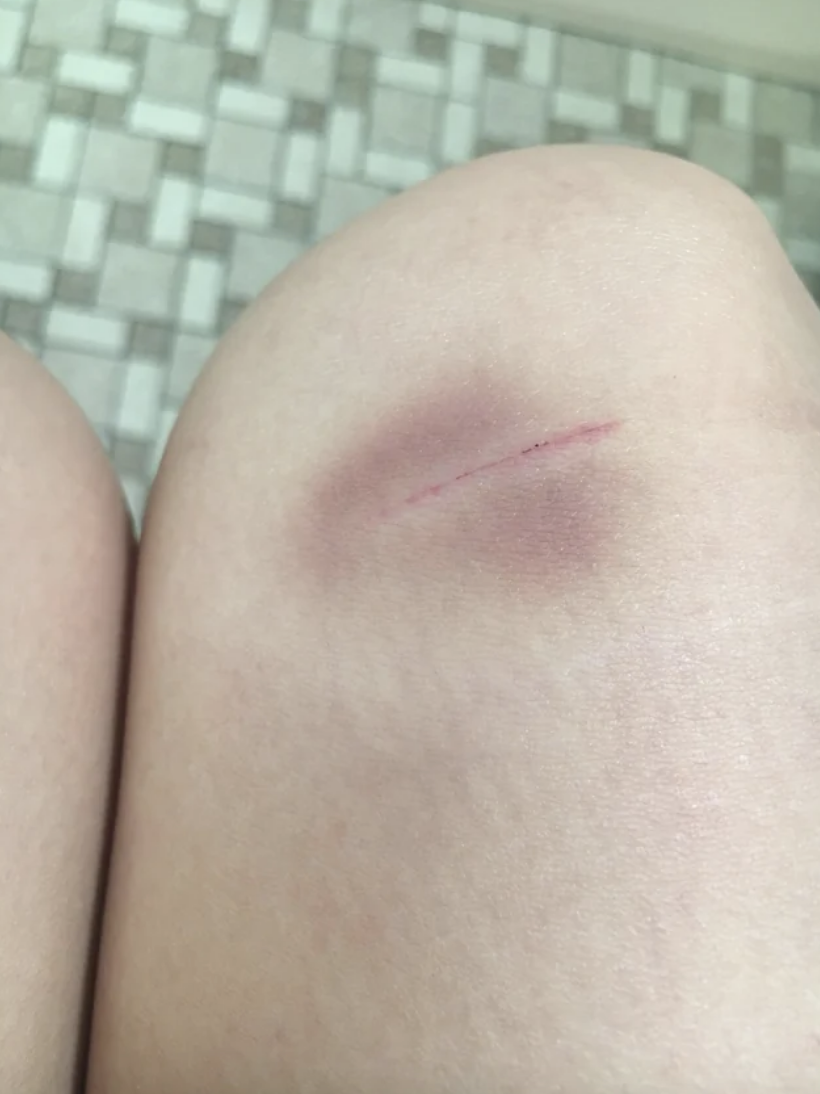 bruise with a cut on it