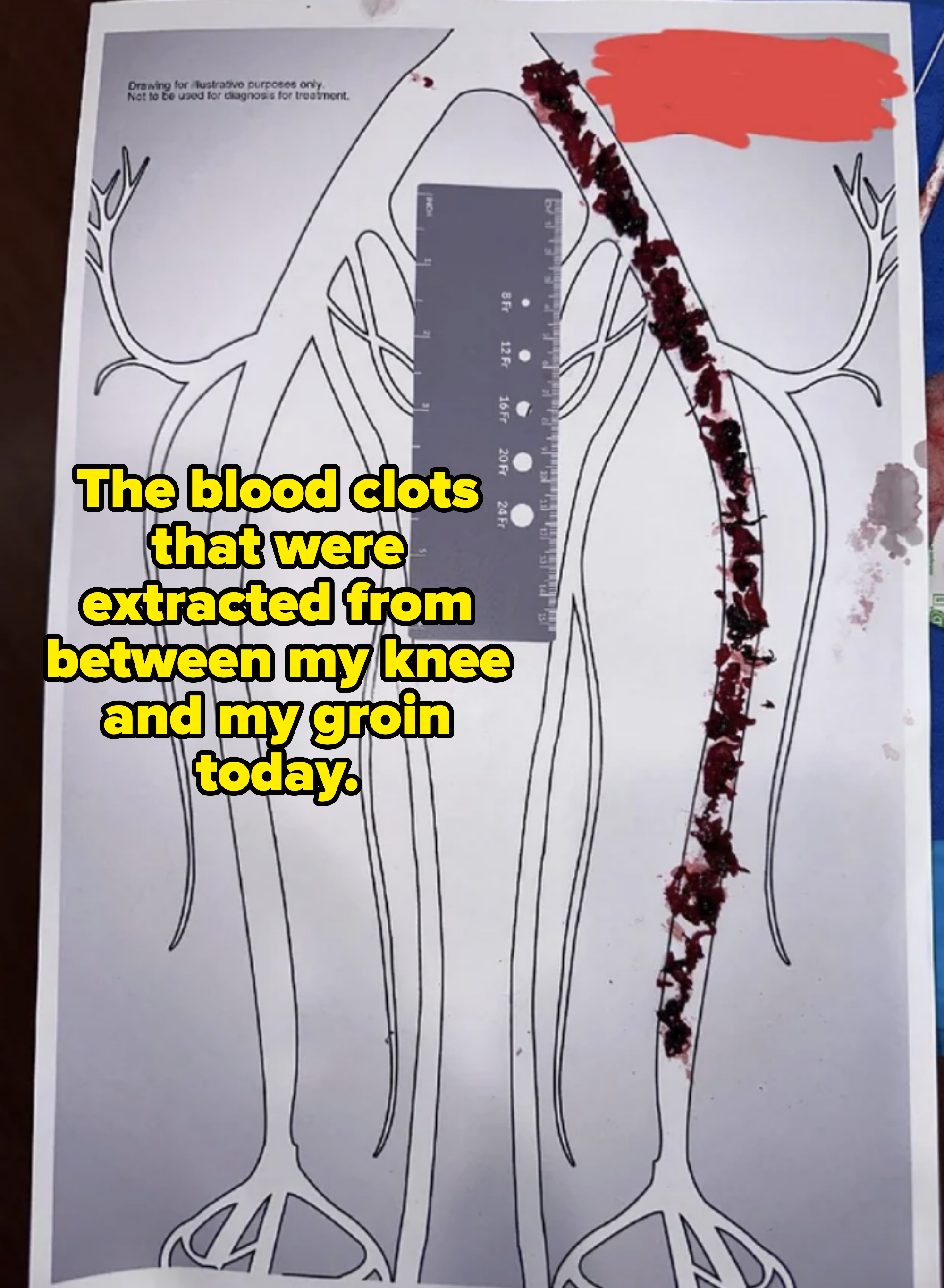 blood clots on surface