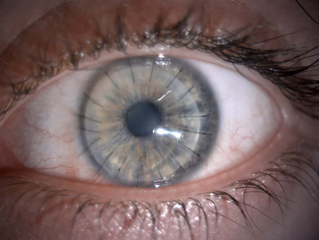 Close-up of a human eye with stitches around cornea