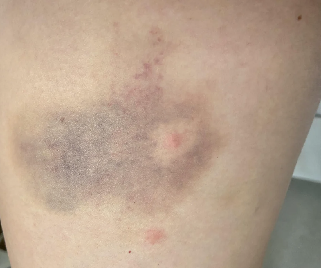 bruise with a mosquito bite on it