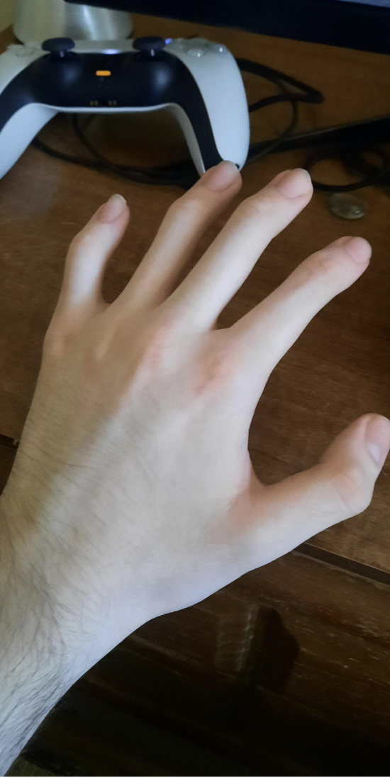 hand with no knuckles