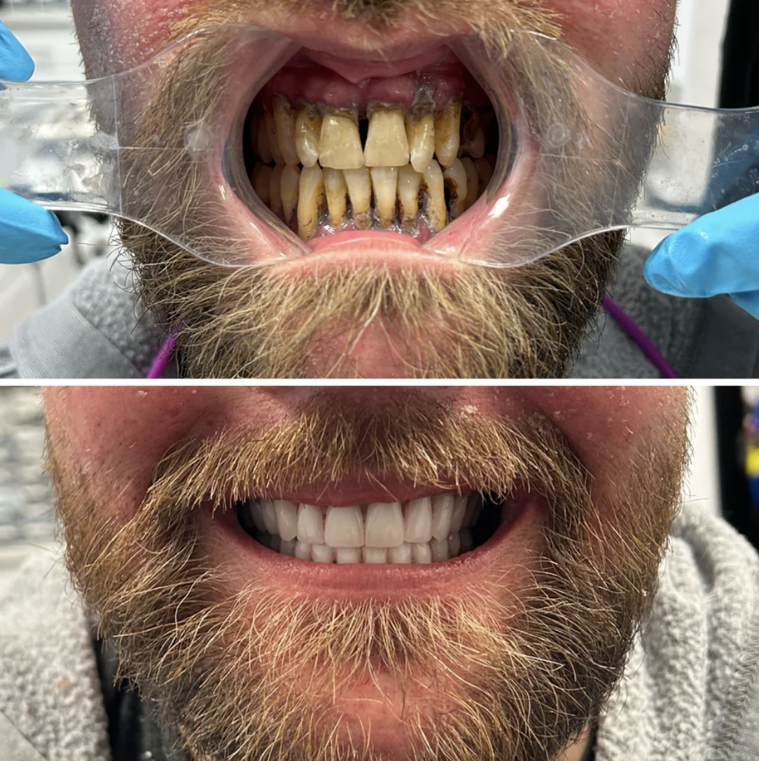 Before and after of teeth cleaning, showing significant improvement