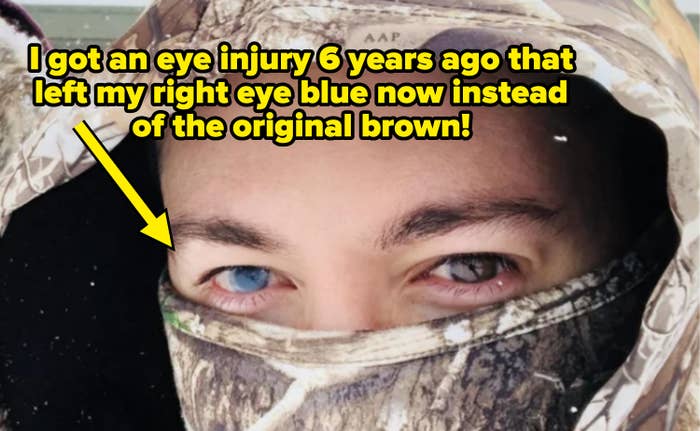 person with one blue eye and one brown
