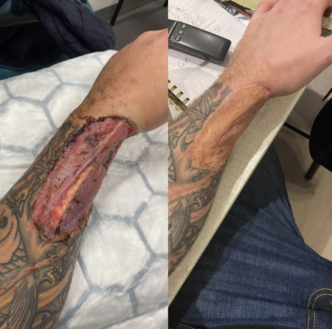 wound on arm, then healed wound on arm