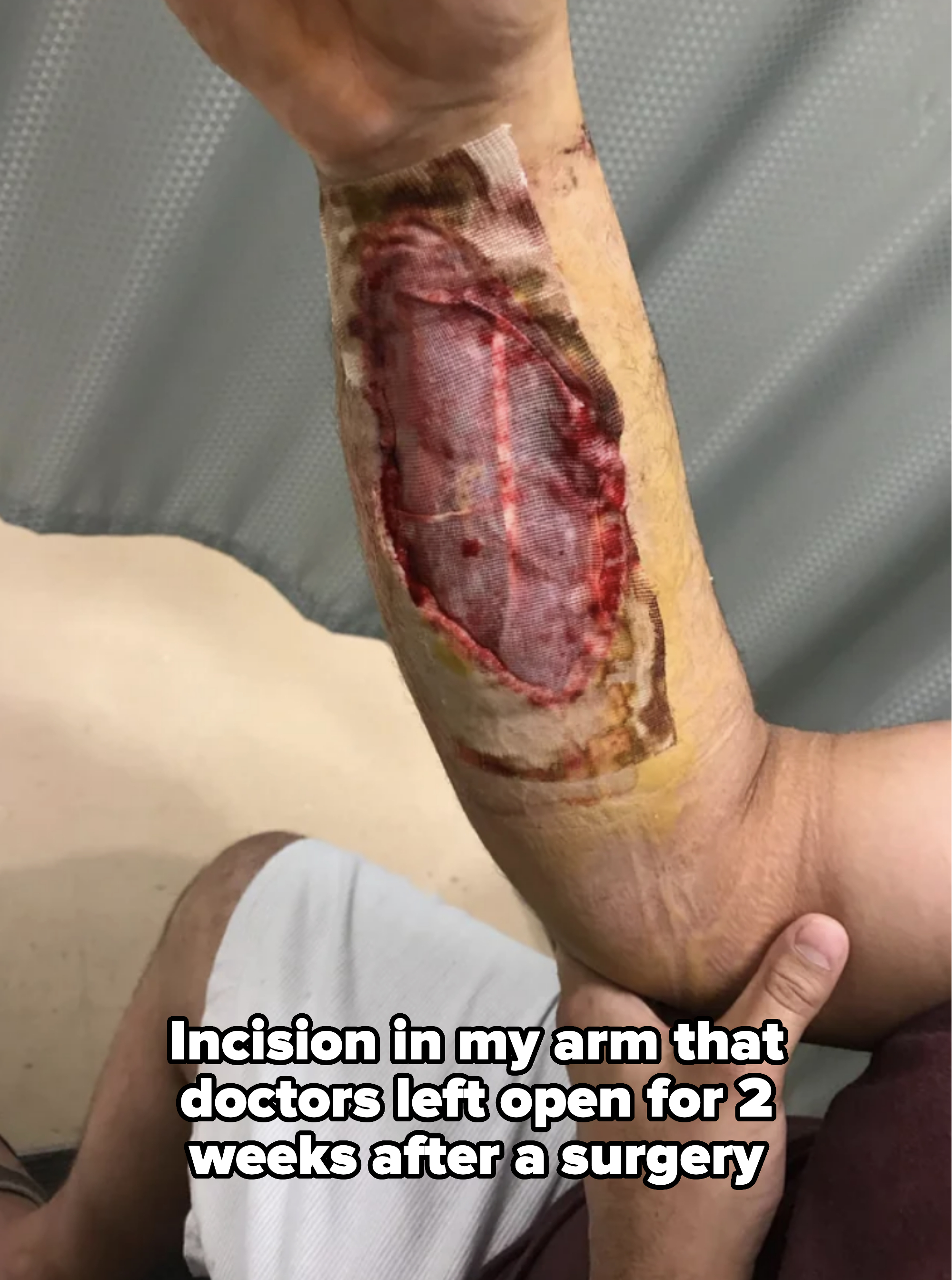 large bandaged open wound