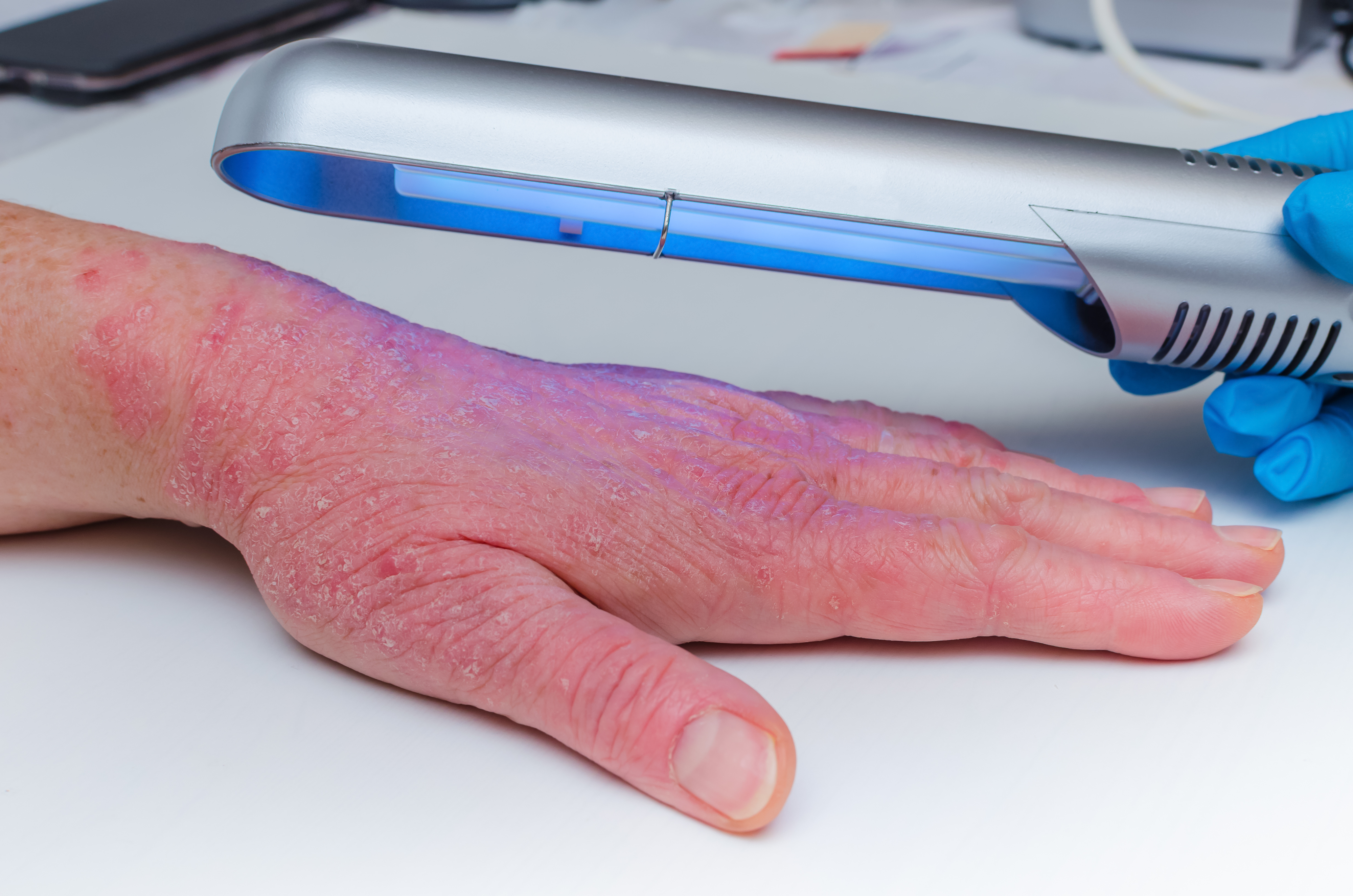 person waving light therapy wand over hand