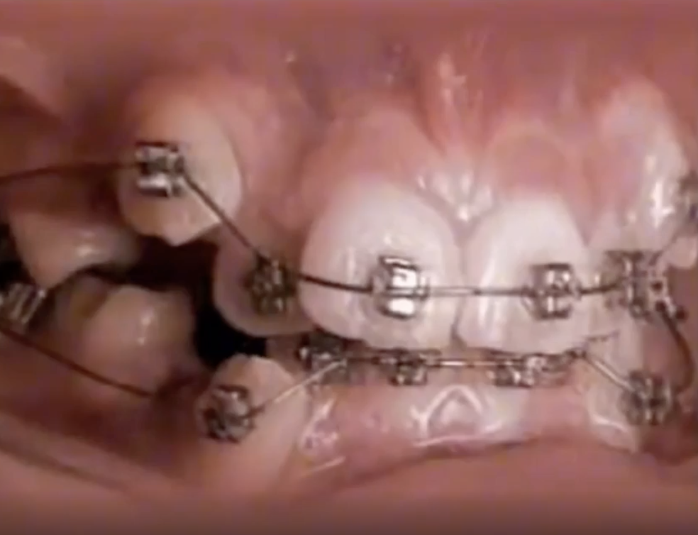 Braces on very crooked teeth