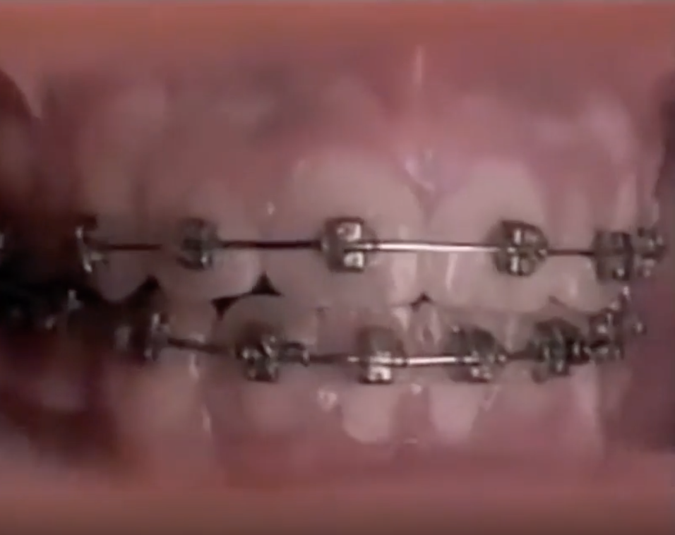 The braces on now-straight teeth