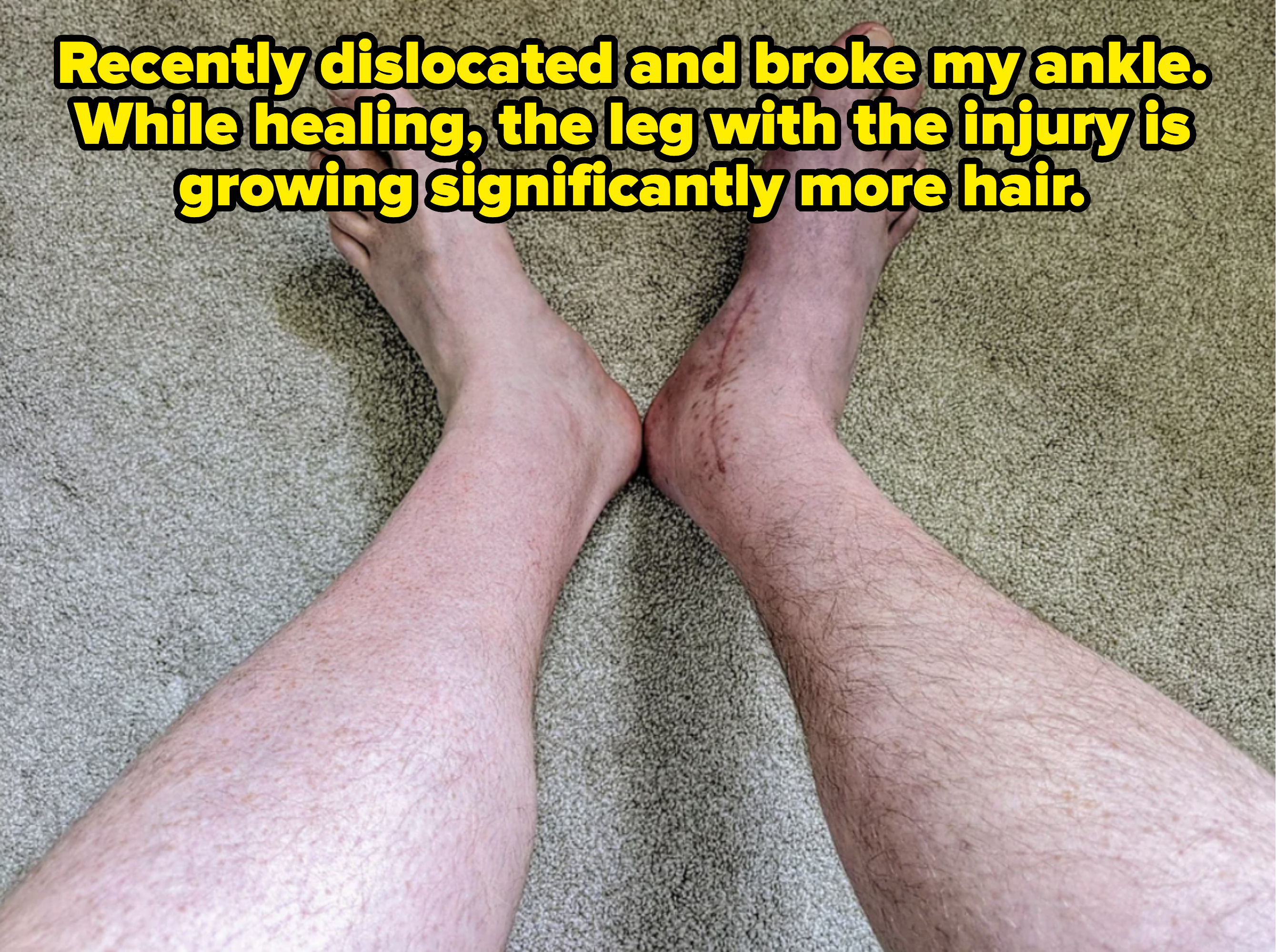 person&#x27;s legs, one injured and with more hair