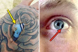 arrow towards brighter tattoo under torn skin and detached pupil in eye