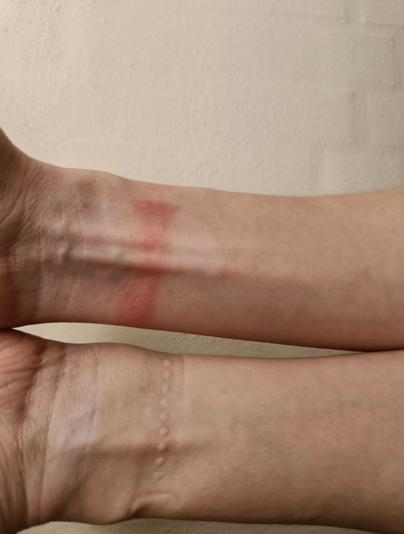Close-up of a person&#x27;s arms with one showing a red band and another just raised bumps