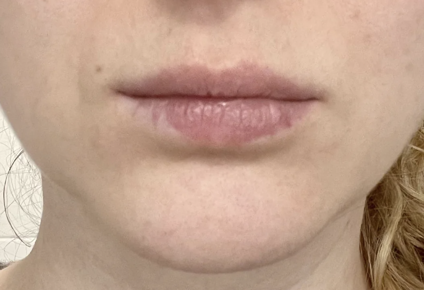 Close-up of a person&#x27;s lips showing a bottom lip with some missing pigmentation on the side and bottom
