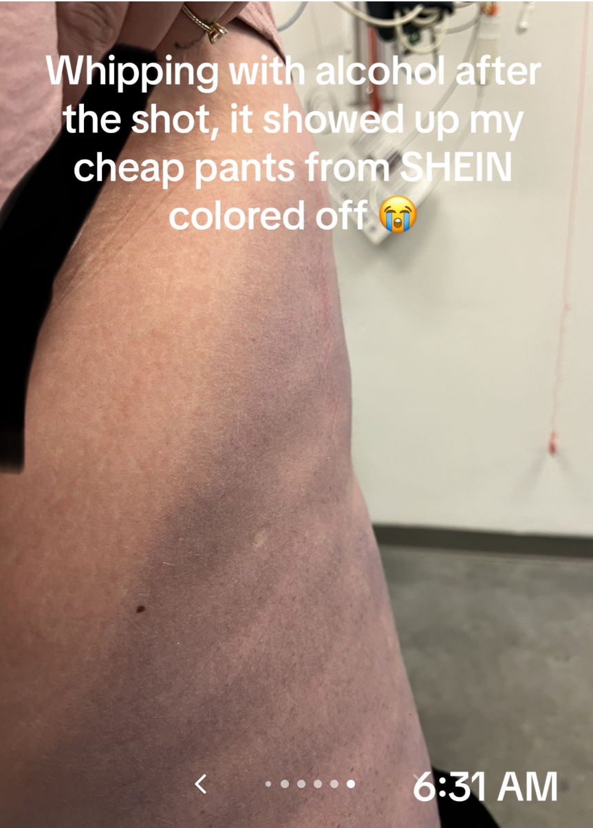 A person shows their arm with color transfer stains from clothing with text: &quot;Wiping with alcohol after the shot, it showed up my cheap pants from Shein colored off&quot;