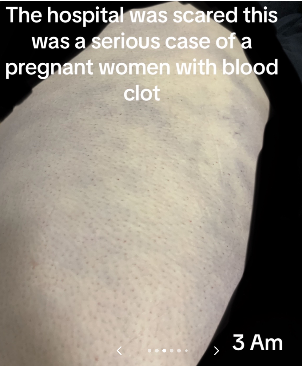 Close-up of a skin surface with text overlay about a hospital and a pregnant woman with a blood clot