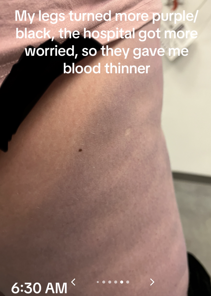Person&#x27;s leg with bruises and text: &quot;My legs turned more purple/black, the hospital got more worried, so they gave me blood thinner&quot;