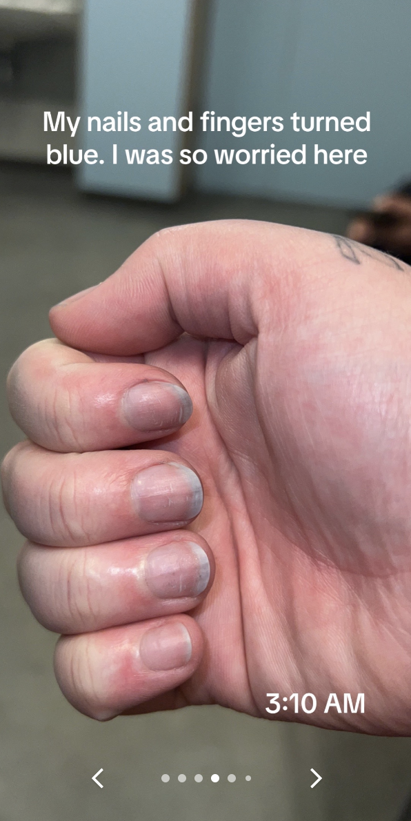 Close-up of a person&#x27;s clasped hands showing nails and fingers with a bluish tint; a tattoo is visible on one finger