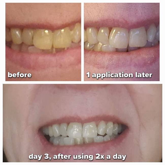 top left: reviewer's before photo with visibly yellow teeth / top right: after one use, teeth looking less yellow / bottom: after the third day of 2x daily applications, teeth are whiter and much less yellow