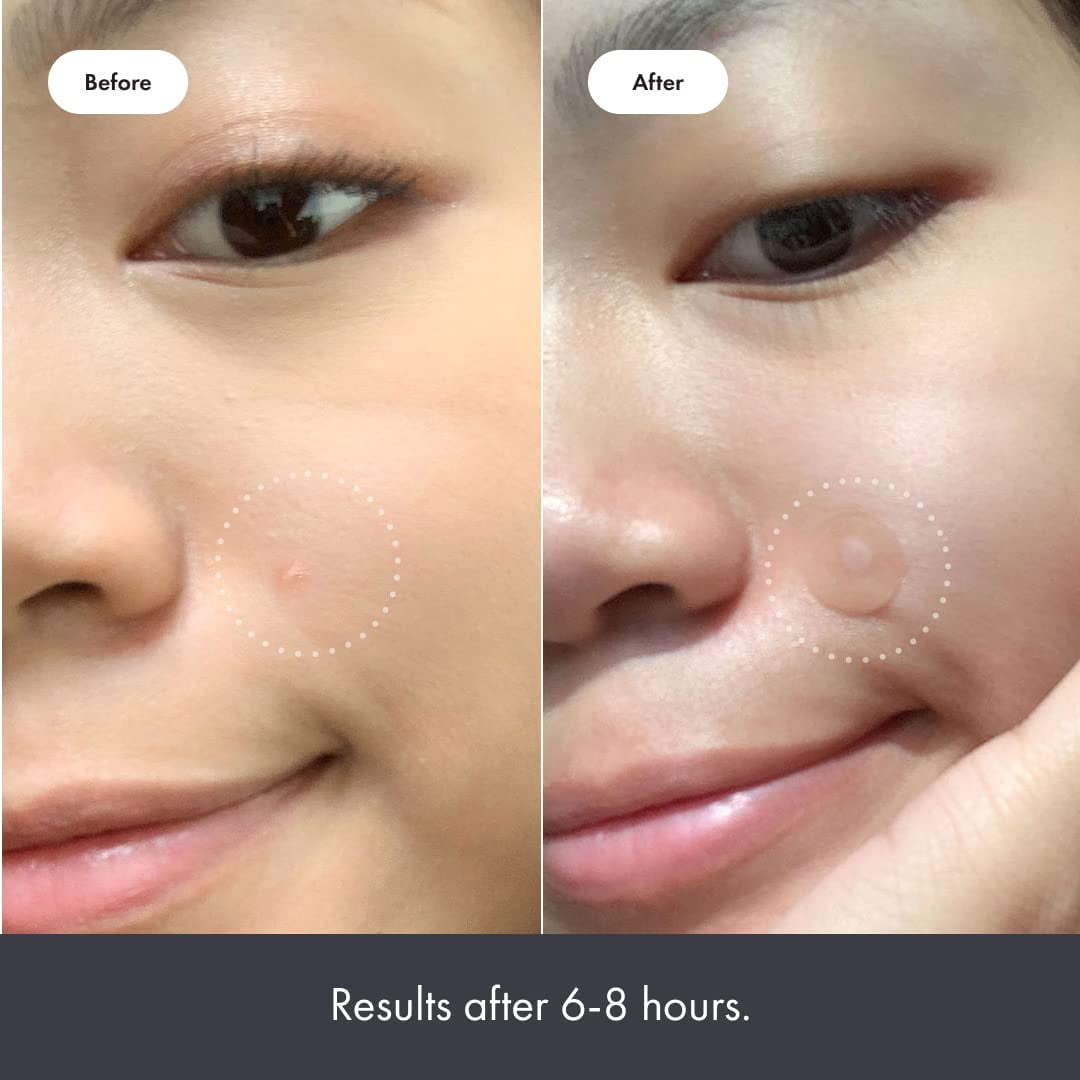 Close-up of a person&#x27;s cheek showing skincare results before and after treatment over 6-8 hours