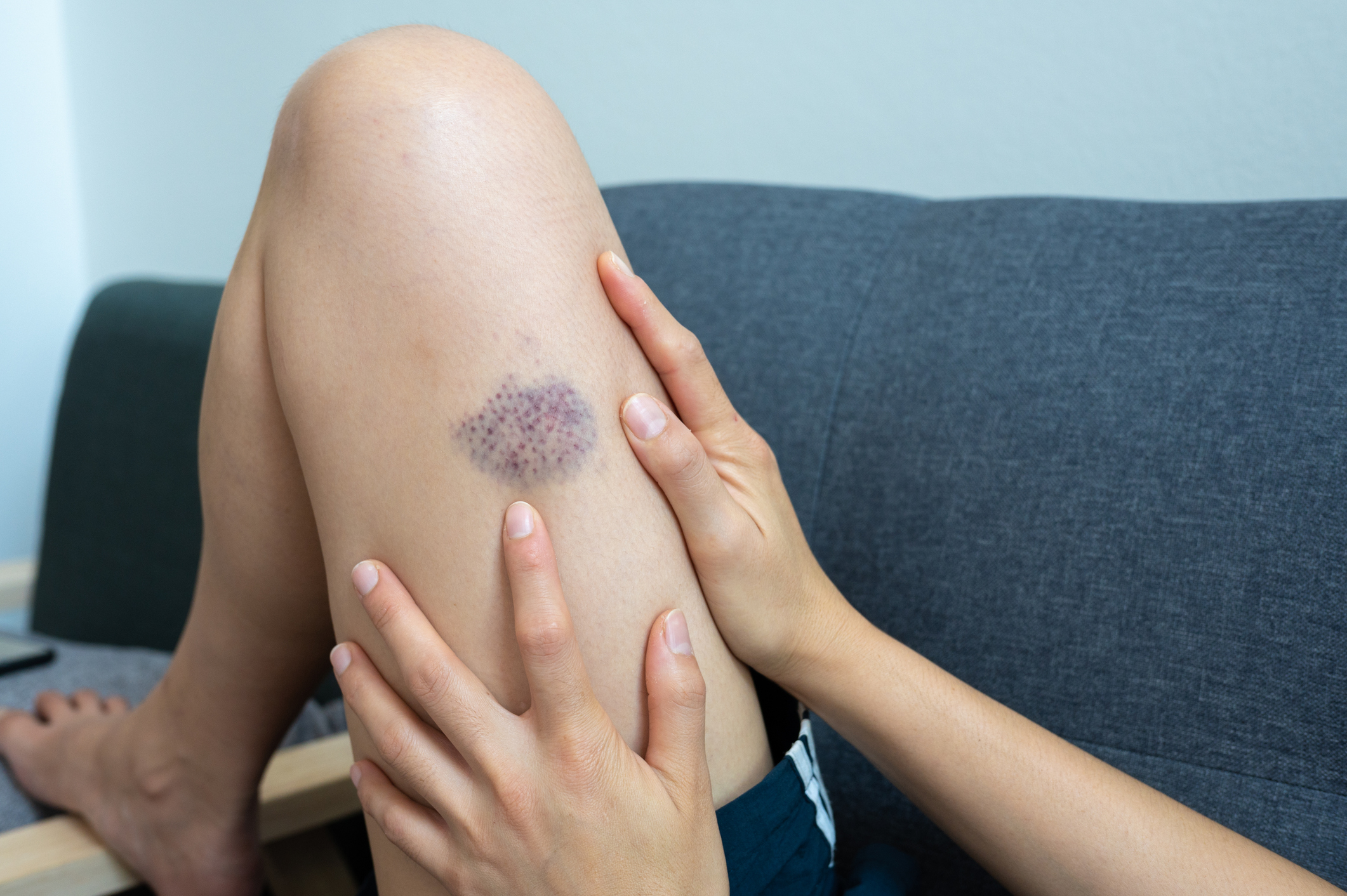 Person examining a bruise on their leg while sitting on a sofa