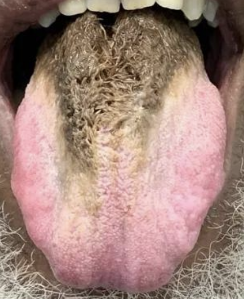 Close-up of a person&#x27;s tongue displaying what looks like thick hair in the center