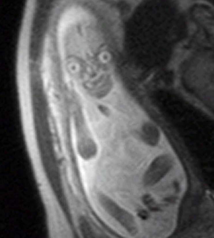 A fetus MRI