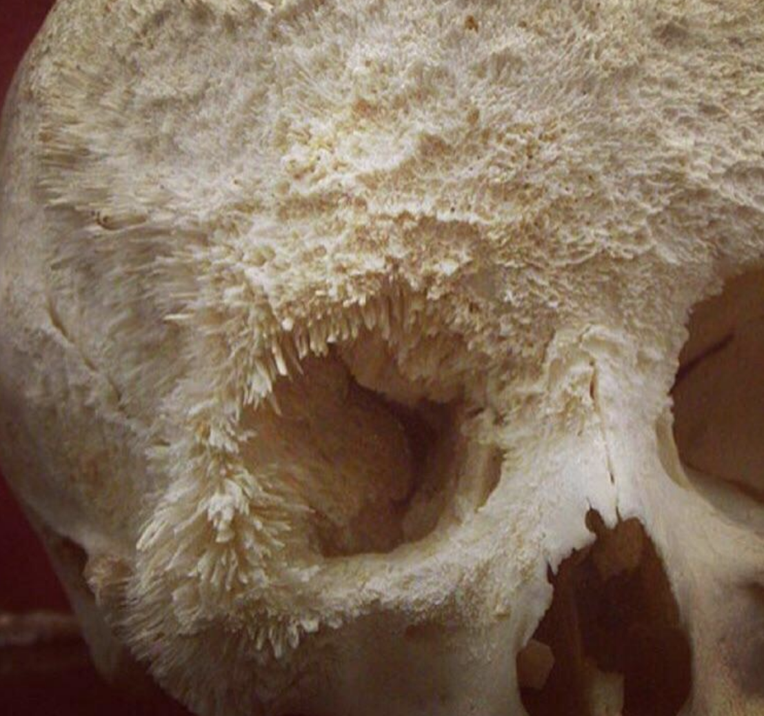 Close-up of a skull with crystal formations where teeth might be. No persons in the image
