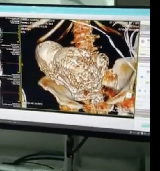 3D medical scan displayed on a computer screen