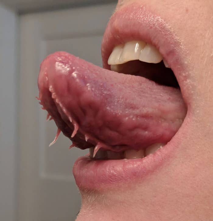 Close-up of a person&#x27;s mouth with their tongue sticking out, showing &quot;tentacle-like&quot; protuberances on the bottom